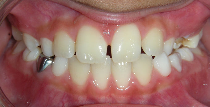 Child's teeth after treatment for an underbite with a plate